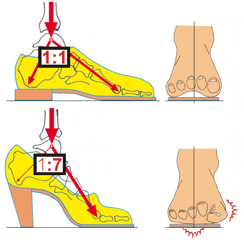Какую обувь носить при плоскостопии - советы по выбору и особенности тренировок при проблемах со стопами (110 фото)