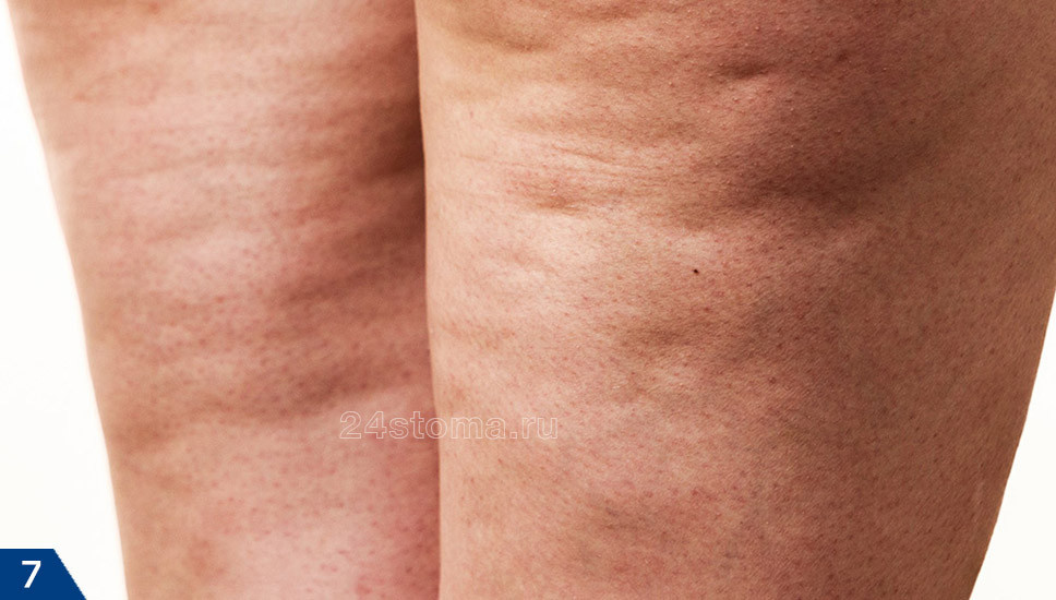 целлюлит 4 стадии (на коже имеется бугристость, ямочки, что свидетельствует о явлениях склероза соединительнотканных волокон))