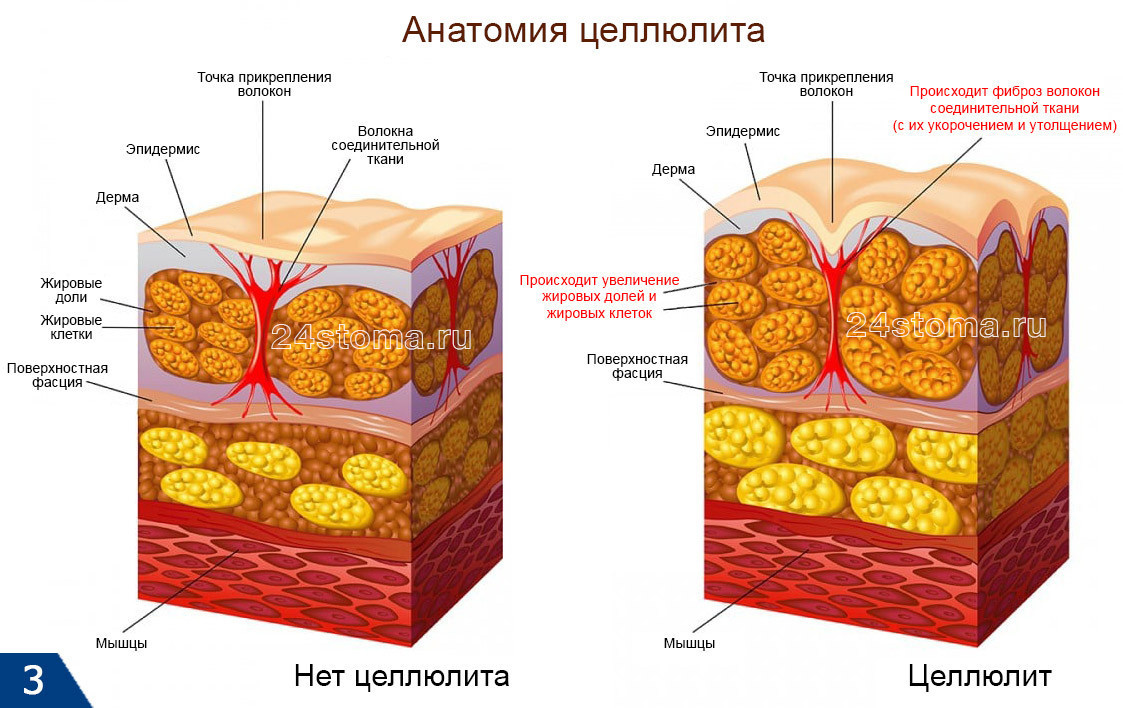 Анатомия целлюлита (с одной стороны наблюдается увеличение жировых клеток и пятен, а с другой – укорочение и утолщение перегородок их соединительнотканных волокон; как следствие – симптом апельсиновой корки)